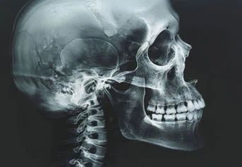 vecteezy_detailed-x-ray-image-of-a-human-skull-showing-bones-and_49072161-342x236.jpeg